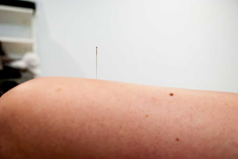 Punción seca en Córdoba